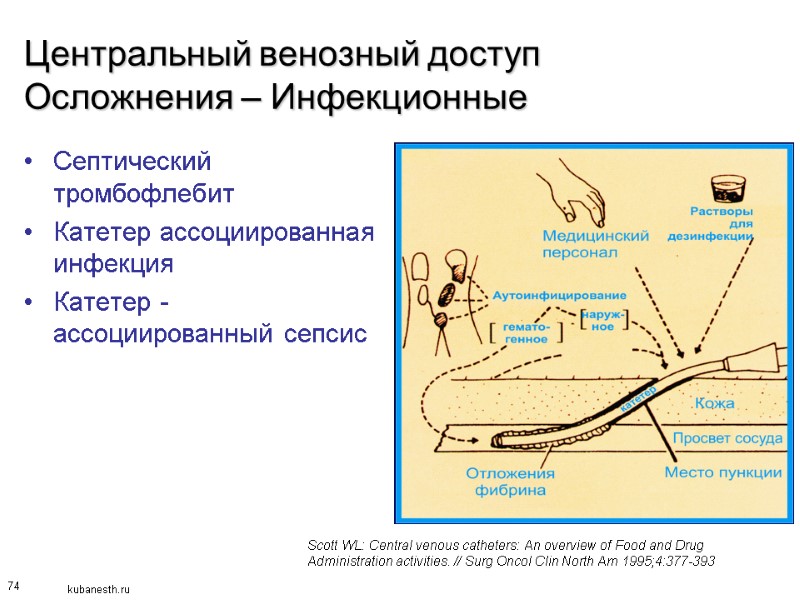 74 Центральный венозный доступ Осложнения – Инфекционные  Септический тромбофлебит Катетер ассоциированная инфекция Катетер